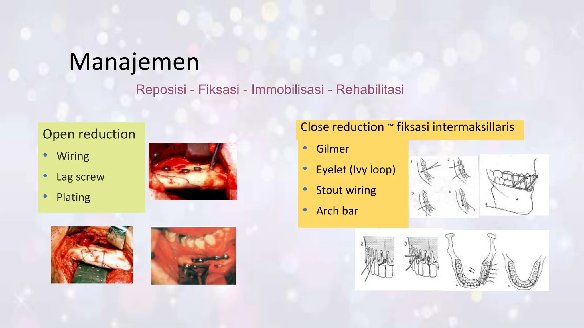 Stout Wire Kuliah Kedokteran Trauma tulang wajah powerpoint | PPTX