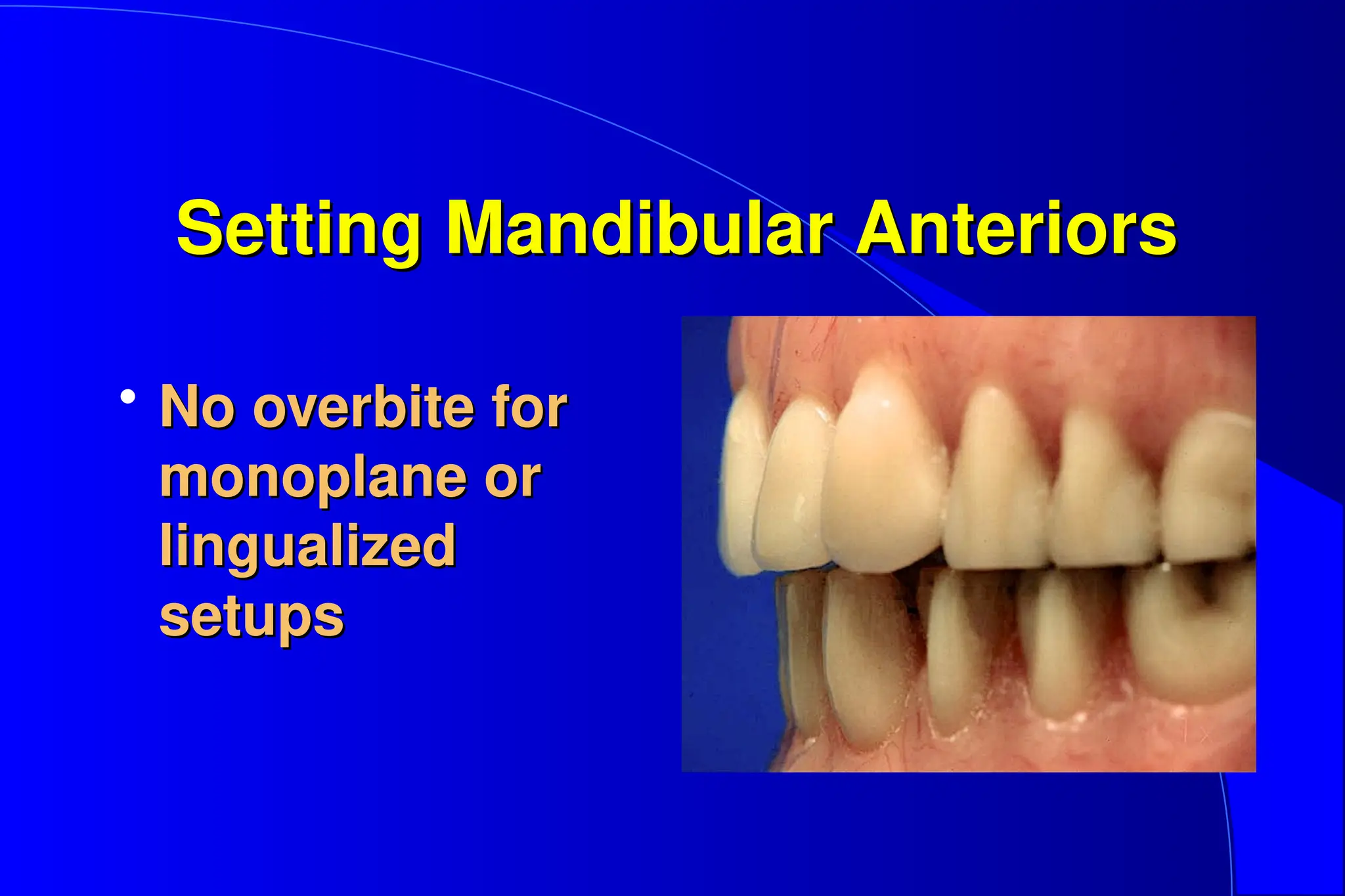 14. Set Anterior Teeth in complete denture.ppt
