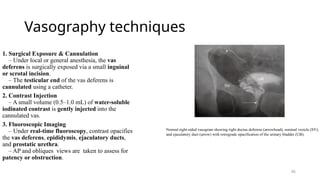 Vasogram 14. Male genital tract radiology anatomy.pptx