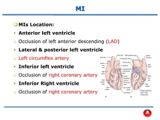 ❑ MIs Location:
▪ Anterior left ventricle
o Occlusion of left anterior descending (LAD)
▪ Lateral & posterior left ventricle
o Left circumflex artery
▪ Inferior left ventricle
o Occlusion of right coronary artery
▪ Inferior Right ventricle
o Occlusion of right coronary artery
MI
 
