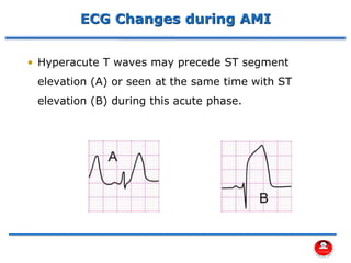 ECG Changes during AMI
• Hyperacute T waves may precede ST segment
elevation (A) or seen at the same time with ST
elevation (B) during this acute phase.
 