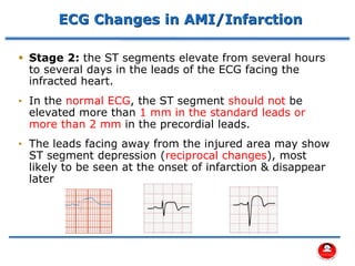 ECG Changes in AMI/Infarction
▪ Stage 2: the ST segments elevate from several hours
to several days in the leads of the ECG facing the
infracted heart.
• In the normal ECG, the ST segment should not be
elevated more than 1 mm in the standard leads or
more than 2 mm in the precordial leads.
• The leads facing away from the injured area may show
ST segment depression (reciprocal changes), most
likely to be seen at the onset of infarction & disappear
later
 
