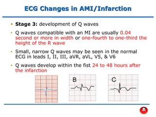 ECG Changes in AMI/Infarction
▪ Stage 3: development of Q waves
• Q waves compatible with an MI are usually 0.04
second or more in width or one-fourth to one-third the
height of the R wave
• Small, narrow Q waves may be seen in the normal
ECG in leads I, II, III, aVR, aVL, V5, & V6
• Q waves develop within the fist 24 to 48 hours after
the infarction
 