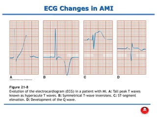 ECG Changes in AMI
Figure 21-8
Evolution of the electrocardiogram (ECG) in a patient with MI. A: Tall peak T waves
known as hyperacute T waves. B: Symmetrical T-wave inversions. C: ST-segment
elevation. D: Development of the Q wave.
 