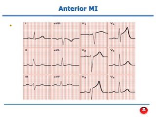 Anterior MI
•
 