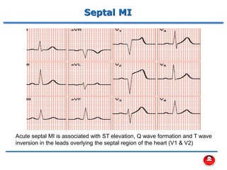 Septal MI
Acute septal MI is associated with ST elevation, Q wave formation and T wave
inversion in the leads overlying the septal region of the heart (V1 & V2)
 