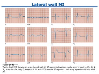 Lateral wall MI
Figure 21-10
Twelve-lead ECG showing an acute lateral wall MI. ST-segment elevations can be seen in leads I, aVL, V5 &
V6. Note also the deep Q waves in II, III, and aVF & normal ST segments, indicating a previous inferior wall
MI.
 
