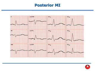 Posterior MI
 