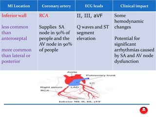 MI Location Coronary artery ECG leads Clinical impact
Inferior wall
less common
than
anteroseptal
more common
than lateral or
posterior
RCA
Supplies SA
node in 50% of
people and the
AV node in 90%
of people
II, III, aVF
Q waves and ST
segment
elevation
Some
hemodynamic
changes
Potential for
significant
arrhythmias caused
by SA and AV node
dysfunction
 