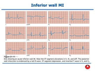 Inferior wall MI
Figure 21-11
ECG showing an acute inferior wall MI. Note the ST-segment elevations in II, III, and aVF. The posterior
wall infarction is evidenced by a tall R wave, ST-segment depression, and inverted T wave in V1 and V2.
 