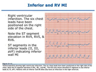 Inferior and RV MI
 Right ventricular
infarction. The six chest
leads have been
positioned on the right
side of the chest.
 Note the ST segment
elevation in RV4, RV5, &
RV6.
 ST segments in the
inferior leads (II, III,
aVF) indicating inferior
wall MI
Figure 21-13
Twelve-lead ECG showing right ventricular infarction. The six chest leads have been positioned on the right side of the
chest. Note the ST-segment elevation in RV4, RV5, and RV6. The ECG also shows elevated ST segments in the inferior
leads (II, III, aVF). Patients with an inferior wall MI often also have an infarction in the right ventricle.
 