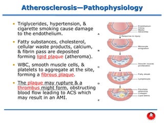 Atherosclerosis—Pathophysiology
• Triglycerides, hypertension, &
cigarette smoking cause damage
to the endothelium.
• Fatty substances, cholesterol,
cellular waste products, calcium,
& fibrin pass are deposited
forming lipid plaque (atheroma).
• WBC, smooth muscle cells, &
platelets to aggregate at the site,
forming a fibrous plaque.
• The plaque may rupture & a
thrombus might form, obstructing
blood flow leading to ACS which
may result in an AMI.
 