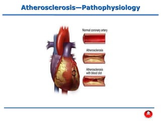 Atherosclerosis—Pathophysiology
 