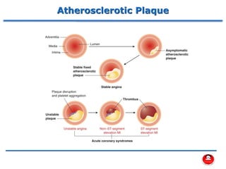 Atherosclerotic Plaque
 