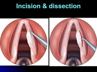 Pharynx Incision 14 -benign- lesions- of- larynx powerpoint | PPTX