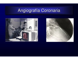 Angiografía Coronaria
Angiografía Coronaria
 