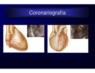 Coronariografía
Coronariografía
 