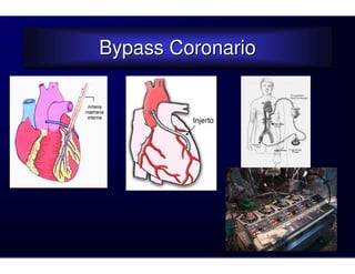 Bypass Coronario
Bypass Coronario
 