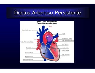 Ductus Arterioso Persistente
Ductus Arterioso Persistente
 