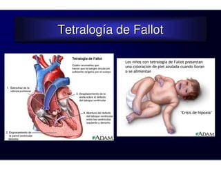 Tetralogía de Fallot
Tetralogía de Fallot
 
