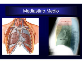 Mediastino Medio
Mediastino Medio
 