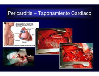 Pericarditis – Taponamiento Cardiaco
Pericarditis – Taponamiento Cardiaco
 