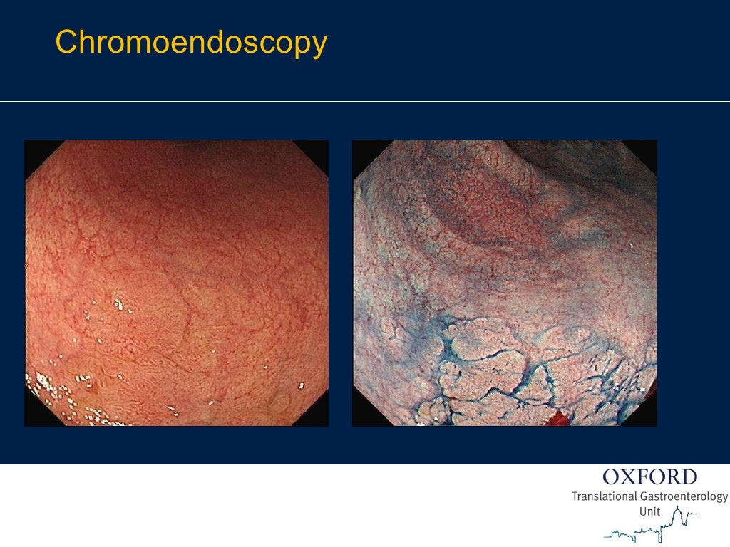 Endoscopy in Gastrointestinal Oncology Slide 14 J. East Endosco…
