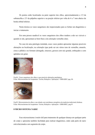 8
Os pontos estão localizados na parte superior dos olhos, aproximadamente a 1/3 da
sobrancelha e 2/3 da pálpebra superior e na porção inferior por volta de 6 a 7 mm abaixo da
borda orbital inferior.
Nesta técnica os vasos sanguíneos são inspecionados para se fechar um diagnóstico e
iniciar o tratamento.
Em uma pessoa saudável os vasos sanguíneos dos olhos tendem a não ser visíveis e
quando os são, apresentam-se bem finos e de coloração vermelho claro.
No caso de uma patologia instalada, esses vasos podem apresentar algumas possíveis
alterações na localização, na coloração (que pode ser em vários tons de vermelho, amarelo,
cinza e pálido) e no formato (alongado, sinuosos, grossos com raiz grande, embaçados e com
apêndice em gota).
Fig.04 - Vasos sanguíneos dos olhos e suas possíveis alterações patológicas.
Fonte: Microssistemas da Acupuntura: Teorias, Relações e Aplicações - EBRAMEC pag. 04.
Fig.05- Microssistema do olhos e sua relação com meridianos energéticos da medicina tradicional chinhesa.
Fonte: Microssistemas da Acupuntura: Teorias, Relações e Aplicações - EBRAMEC, pag 01
8 MICRO SISTEMA NARIZ
Esse microssistema é muito útil para tratamento de qualquer doença em qualquer parte
do corpo e apresenta também facilidade para realizar diagnóstico, onde cada parte do nariz
está relacionada a um segmento do corpo.
 