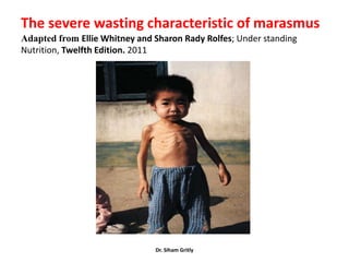 The severe wasting characteristic of marasmus
Adapted from Ellie Whitney and Sharon Rady Rolfes; Under standing
Nutrition, Twelfth Edition. 2011




                               Dr. Siham Gritly
 