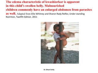 The edema characteristic of kwashiorkor is apparent
in this child’s swollen belly. Malnourished
children commonly have an enlarged abdomen from parasites
as well. Adapted from Ellie Whitney and Sharon Rady Rolfes; Under standing
Nutrition, Twelfth Edition. 2011




                                   Dr. Siham Gritly
 