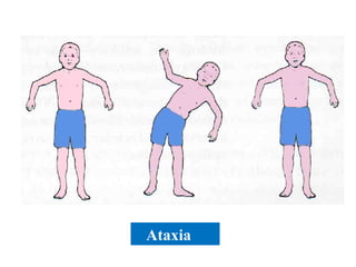 Ataxia 