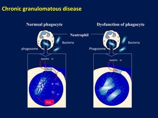 Bacteria phagosome Bacteria Phagosome Neutrophil NADPH  H + NADPH  H + e -   +O 2 O 2 - H + H 2 O 2 Normsal phagocyte Dysfunction of phagocyte Chronic granulomatous disease 