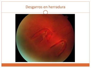 Desgarros en herradura