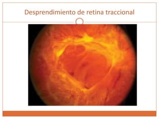 Desprendimiento de retina traccional