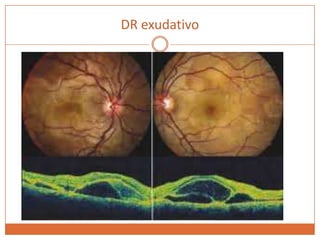 DR exudativo