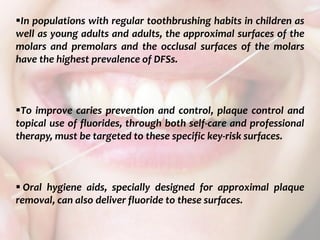  c
topical fluorides 104
In populations with regular toothbrushing habits in children as
well as young adults and adults, the approximal surfaces of the
molars and premolars and the occlusal surfaces of the molars
have the highest prevalence of DFSs.
To improve caries prevention and control, plaque control and
topical use of fluorides, through both self-care and professional
therapy, must be targeted to these specific key-risk surfaces.
 Oral hygiene aids, specially designed for approximal plaque
removal, can also deliver fluoride to these surfaces.
 