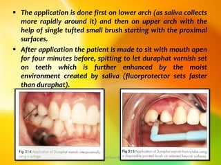 The application is done first on lower arch (as saliva collects
more rapidly around it) and then on upper arch with the
help of single tufted small brush starting with the proximal
surfaces.
 After application the patient is made to sit with mouth open
for four minutes before, spitting to let duraphat varnish set
on teeth which is further enhanced by the moist
environment created by saliva (fluorprotector sets faster
than duraphat).
topical fluorides 20
 