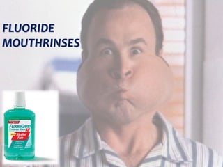  c
topical fluorides 81
FLUORIDE
MOUTHRINSES
 