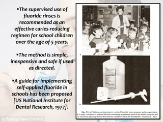  c
topical fluorides 86
The supervised use of
fluoride rinses is
recommended as an
effective caries-reducing
regimen for school children
over the age of 5 years.
The method is simple,
inexpensive and safe if used
as directed.
A guide for implementing
self-applied fluoride in
schools has been proposed
[US National Institute for
Dental Research, 1977].
 