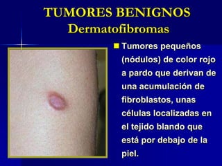 “en Catacaos,en Aplao y Arequipa donde se consume mucha chicha, hemos visto numerosos ejemplos, algunos con Rinofimia”  P. WeissWeiss P. Geografía de las enfermedades en el Perú en relación con las zonas climáticas An Fac med. 2008;69 Supl 2