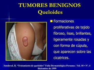 LESIONES PREMALIGNAS Queratosis Actínica	Neoformaciones celulares que se desarrollan por excesiva exposición al sol.  Pueden  dar lugar a un carcinoma escamoso.