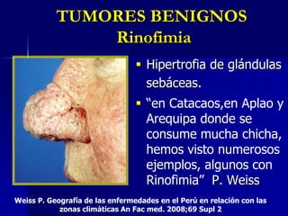 LESIONES PREMALIGNAS Queratosis ActínicaSon muy abundantes y variados en pacientes mayores de piel clara.Placa pequeña, áspera, de color eritematoso o amarillento. Ca in situ intraepidérmico.AREVALO-SUAREZ, Fernando y ALFARO-LOZANO, Alejandro. Queratosis actínica y presencia de p53: hallazgos histopatológicos. Dermatol. peru., mayo/agosto 2006, vol.16, no.2, p.139-142. ISSN 1028-7175. 