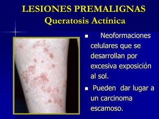 Con escama fina, seca y adherente.Borde bien definido.Son fáciles de palpar.Áreas fotoexpuestas: cara, áreas no pilosas del cuero cabelludo, orejas, dorso de manos y antebrazo.LESIONES PREMALIGNAS Queratosis Actínica