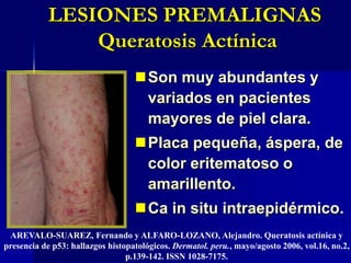 Nevus sebáceo de Jadassohn Descrito en 1895.Nevo organoide.Congénito.Tipo hamartoidea.Verrucoso.J Am Acad Dermatol 2000; 42: 263-8.