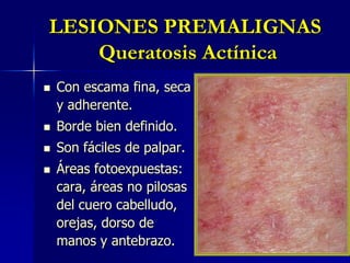 Nevus sebáceo de Jadassohn Coloración cérea.Crece en la adolescencia.J Am Acad Dermatol 2000; 42: 263-8.