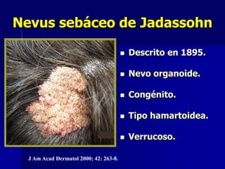 Nevus sebáceo de Jadassohn Placa alopécica.Cara y cuero cabelludo.Hipertrofia de glándulas sebáceas.Diferenciar de: queratosis seborreica.10% degenera Ca.Basocelular.Am J Dermatophatol 2000; 22 108 -18.