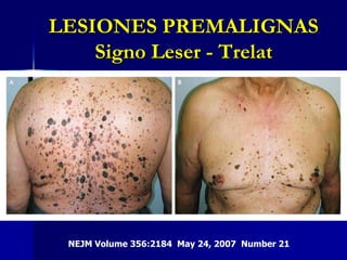  Frecuente: tronco y 	sienes.LESIONES PREMALIGNASSigno Leser - TrelatNEJM Volume 356:2184  May 24, 2007  Number 21