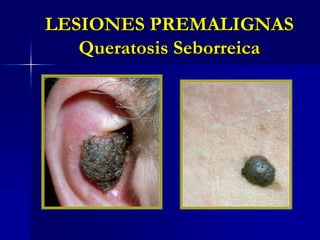 LESIONES PREMALIGNASQueratosis Seborreica