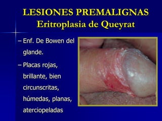 LESIONES PREMALIGNASEritroplasia de QueyratEnf. De Bowen del glande.Placas rojas, brillante, bien circunscritas, húmedas, planas, aterciopeladas