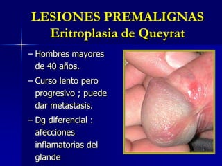 LESIONES PREMALIGNASEritroplasia de QueyratHombres mayores de 40 años.Curso lento pero progresivo ; puede dar metastasis. Dg diferencial : afecciones inflamatorias del glande